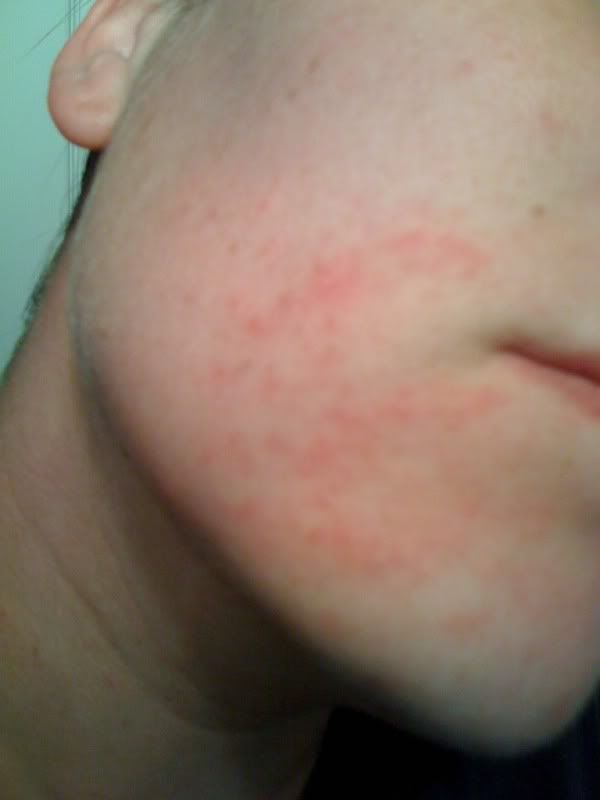 Face Rash Or Help Babygaga